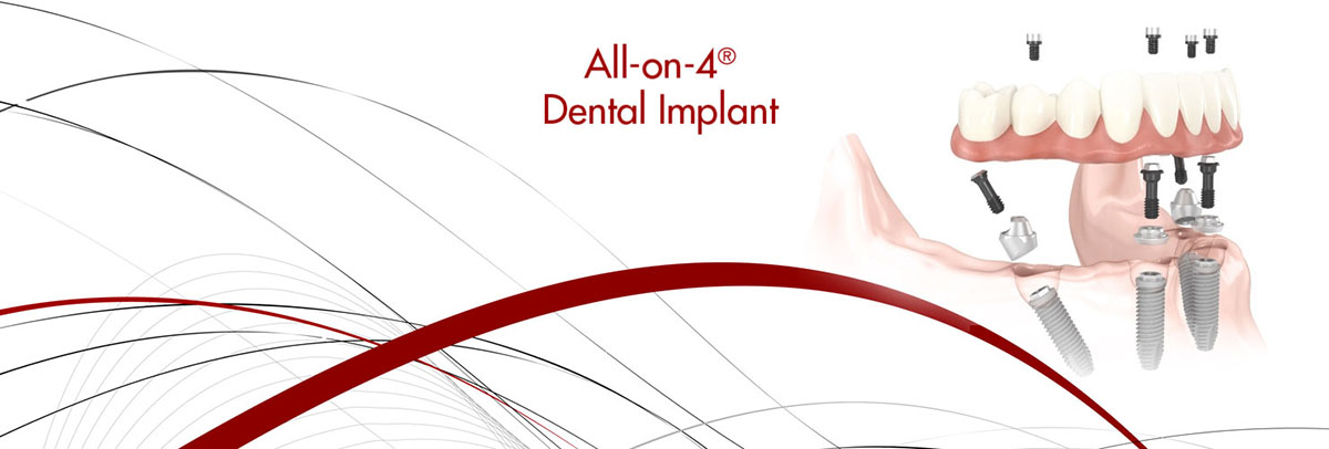 New York All-on-4 Dental Implants