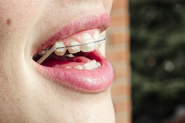 How Long Does Treatment With Clear Braces Normally Take?