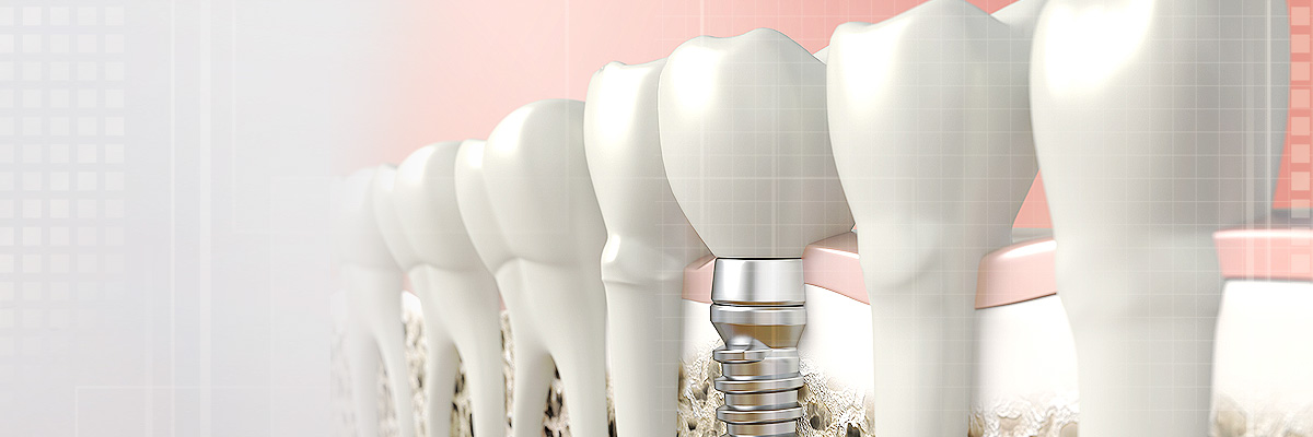 New York Implant Dentist