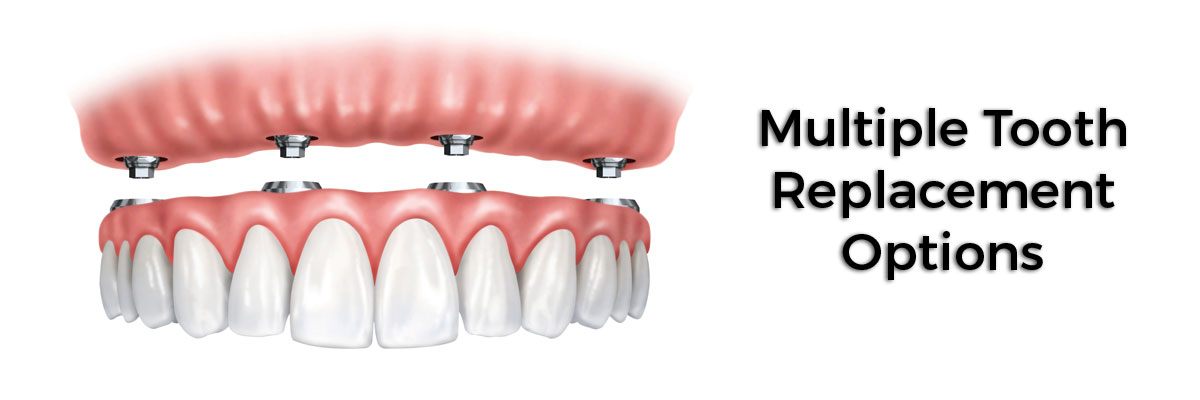 New York Multiple Teeth Replacement Options