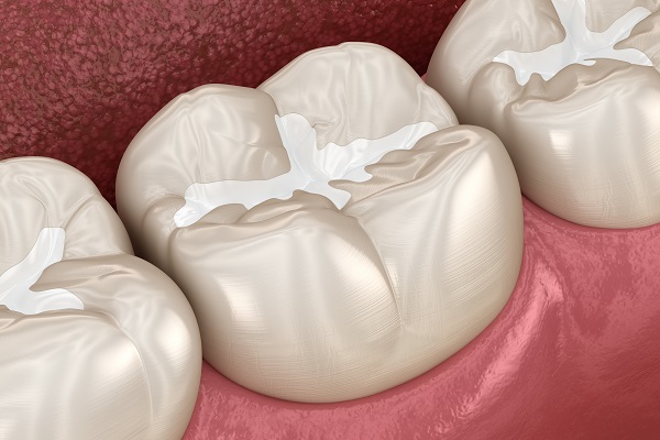 Questions And Answers About The Tooth Filling Process